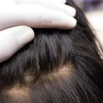 5 Factors to Consider When Choosing a Lice Doctor